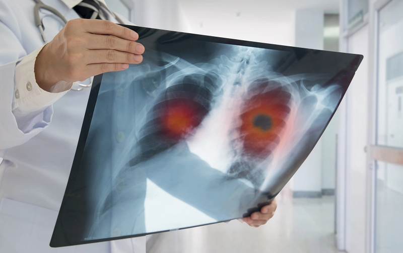 X-ray of chest